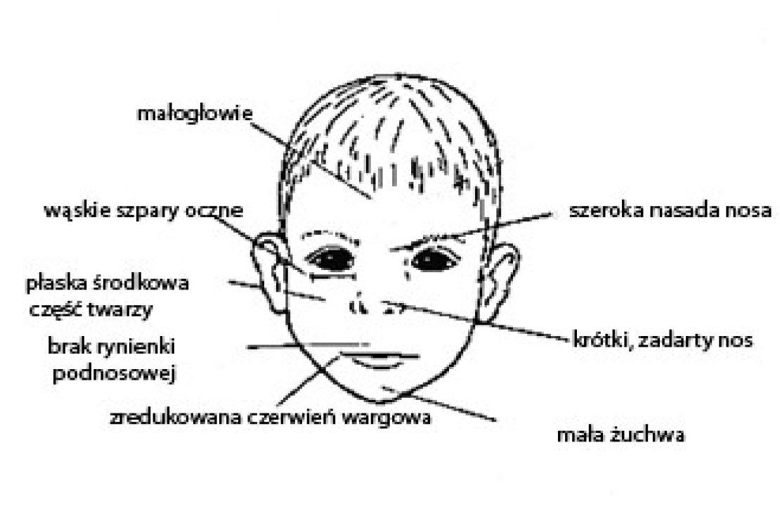 Rysunek twarzy dziecka z zaznaczonymi eleementami: małogłowie; wąskie szpary oczne; płaska środkowa część twarzy; brak rynienki podnosowej; zredukowana czerwień wargowa; mała żuchwa; krótki, zadarty nos; szeroka nasada nosa